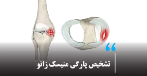 تشخیص پارگی منیسک زانو