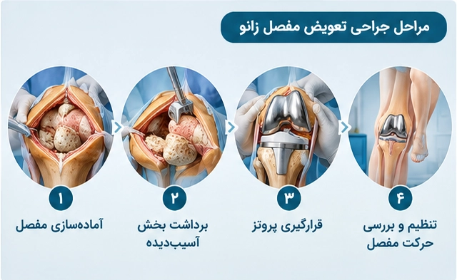 مراحل عمل تعویض مفصل زانو