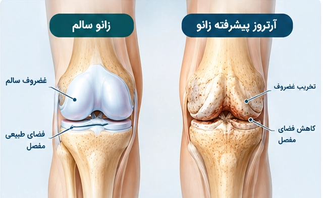 تعویض مفصل زانو