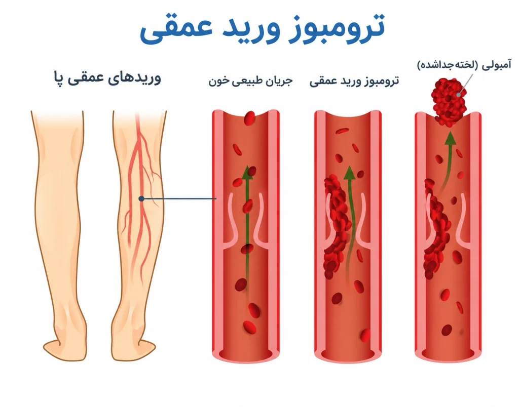تصویر آموزشی ترومبوز ورید عمقی ساق پا (DVT) - ورم و درد بعد از تعویض مفصل زانو