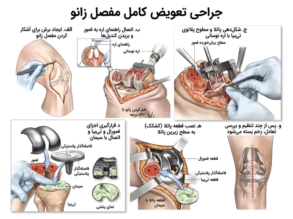مراحل جراحی تعویض مفصل زانو و جایگزینی سطوح آسیب‌دیده مفصل با پروتز